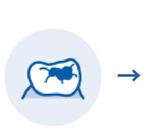 虫歯が小さな場合の修復治療①