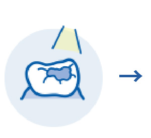 虫歯が小さな場合の修復治療③
