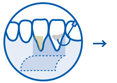 歯周組織再生療法②歯石の除去
