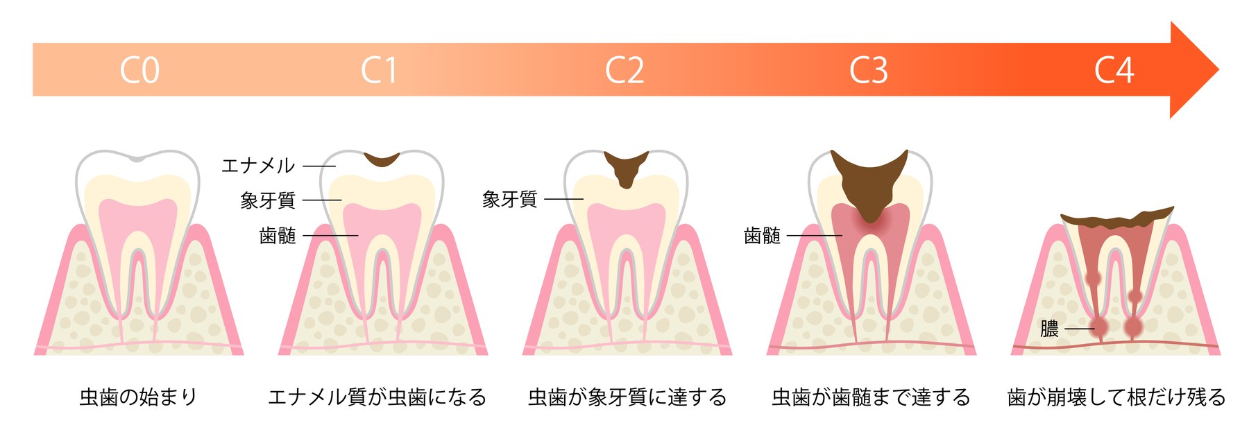 むし歯の進行度（C0〜C4）と歯の断面の図