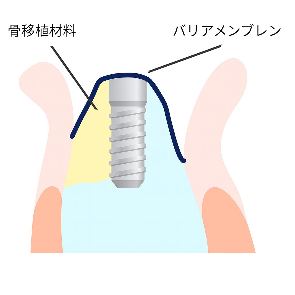 GBRとはどのような処置か